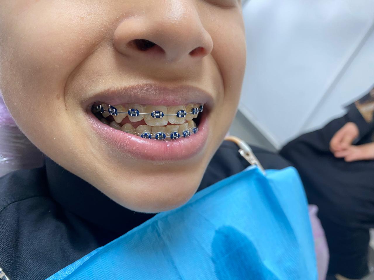 Traitement orthodontique en cours au Centre Dentaire Dr Moumen El Mehdi à Casablanca